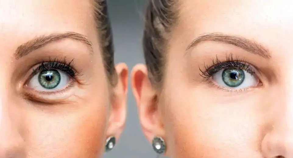 Before and after results of HIFU treatment in real patients