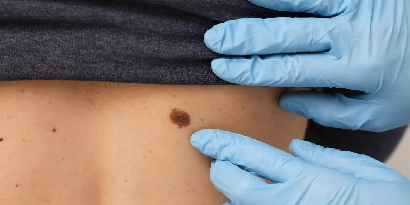 Dermatological examination of suspicious moles on skin