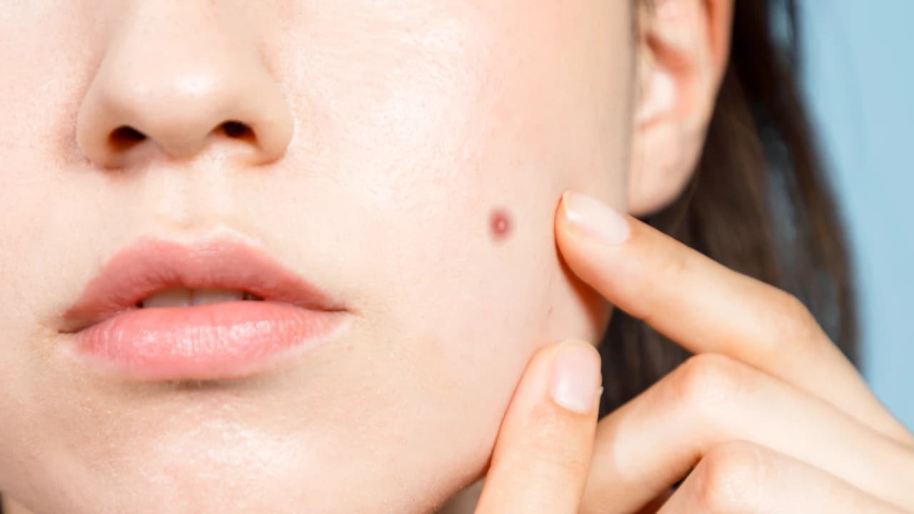 Examples of different types of moles on human skin
